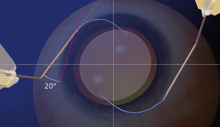 When performing Yamane’s double-needle technique, you find your sclerotomy sites by combining the use of an axis marker, caliper, and ink. In addition, when piercing the conjunctiva and advancing through sclera, you have no control over recommended insertion angles for creating the scleral tunnels. The combination of these variables are a challenge for reproducibility and standardization.